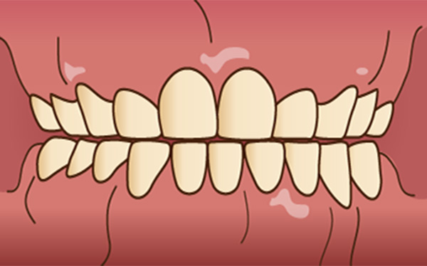 歯ぎしり・食いしばりの悪影響